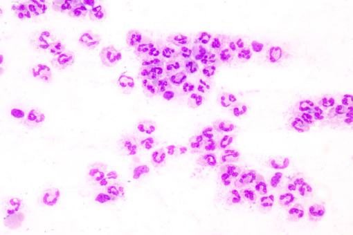 NEU – znaczenie diagnostyczne