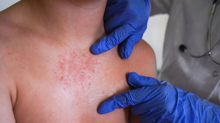 Największe ognisko odry w USA od lat